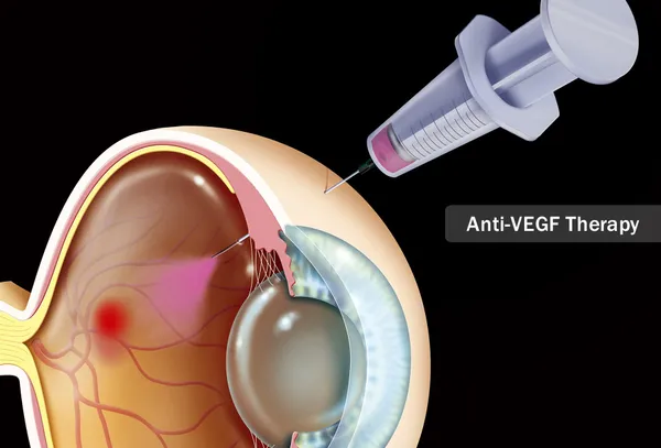 wet amd treatment