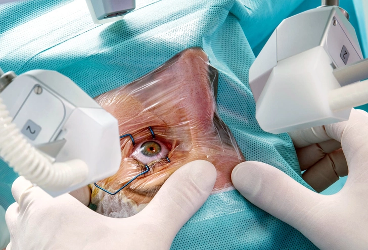 Laser Surgery
