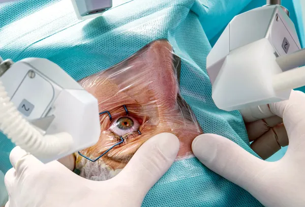 laser eye surgery