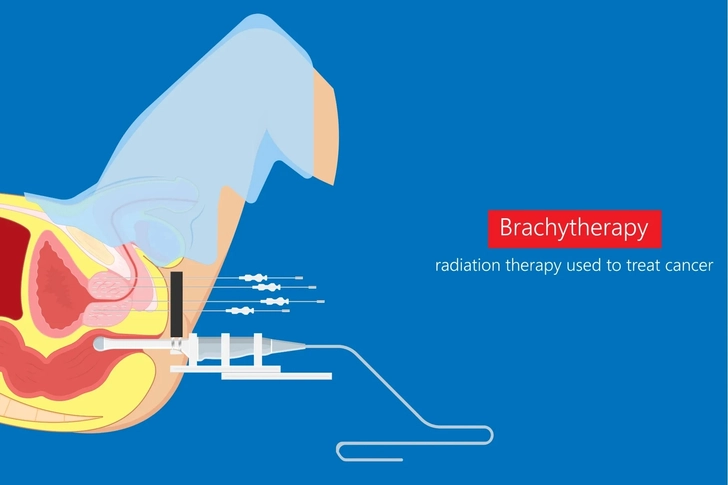 Permanent (Low Dose Rate) Brachytherapy: LDR 