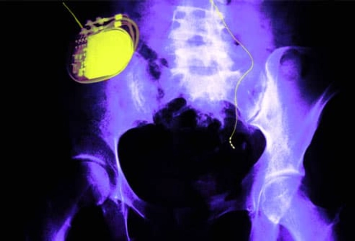 Incontinence Surgery and Other Options Incontinence Surgery and Other Options