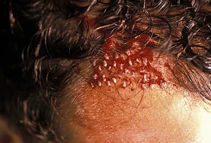 Hair Transplant Hair Transplant