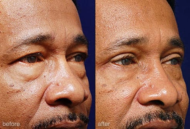 Eyelid Surgery Eyelid Surgery
