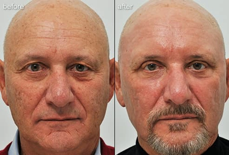 Laser Skin Resurfacing