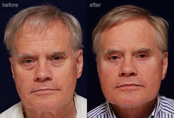 Facelift