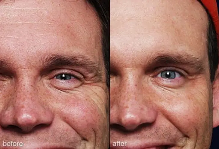 Botox Botox