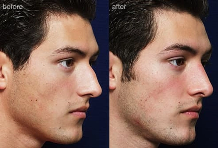Nose Surgery Nose Surgery