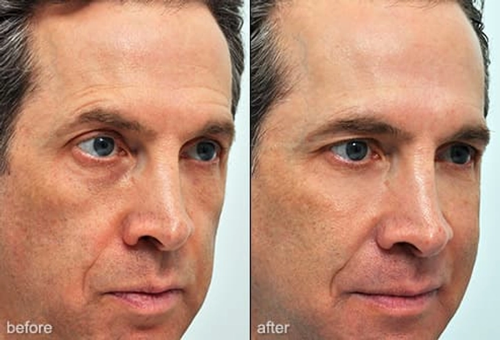 Soft Tissue Fillers
