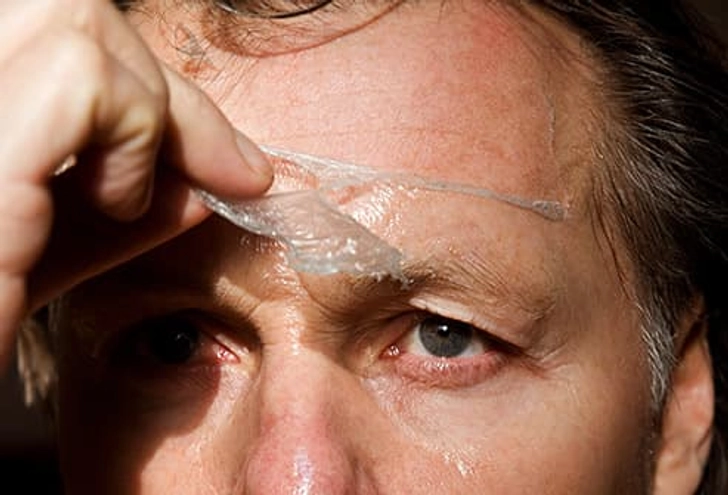 Chemical Peel