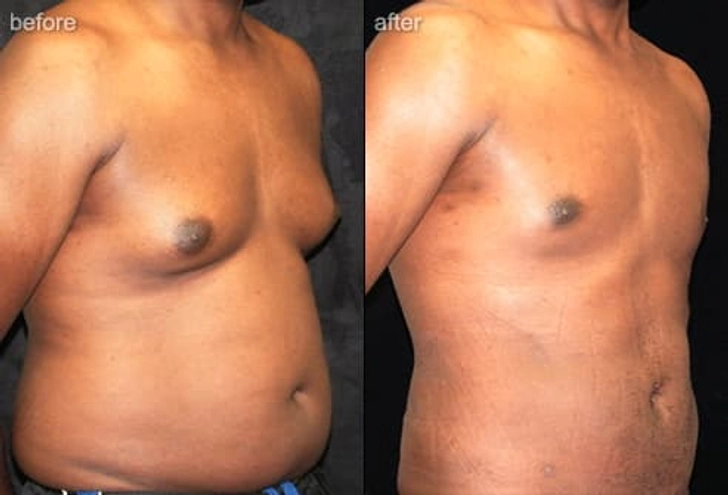 Liposuction