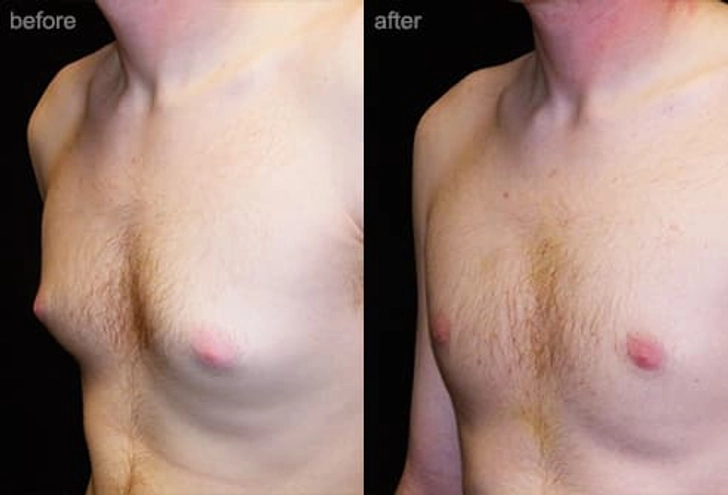 Breast Reduction Breast Reduction