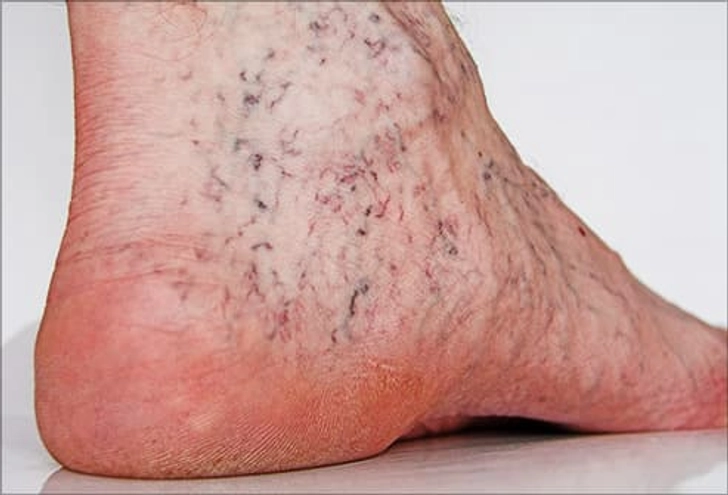 Laser Treatment for Spider Veins