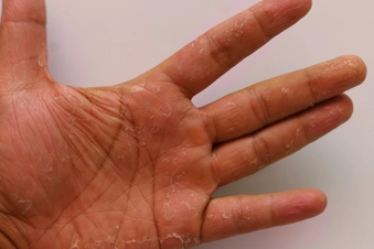 Hand-Foot Syndrome