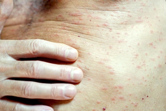 Other Skin Irritations
