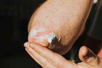 Get Psoriasis Under Control