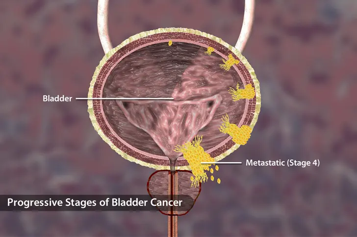 How do bladder cancer symptoms change after metastasis? How do bladder cancer symptoms change after metastasis?