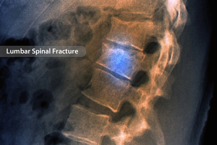 Bone Pain and Increased Fracture Risk Bone Pain and Increased Fracture Risk