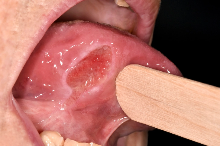 What Do Ulcers Look Like? What Do Ulcers Look Like?