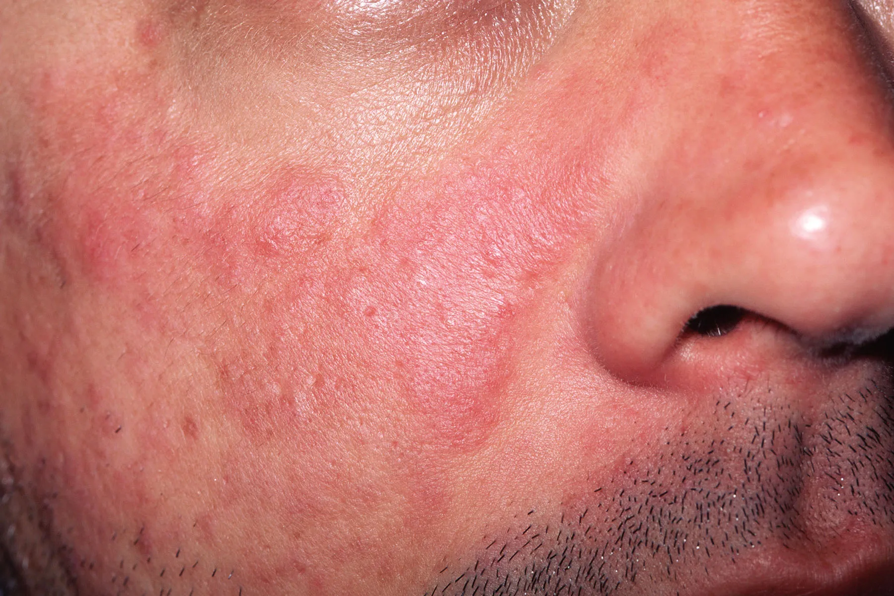 photo of lupus on face