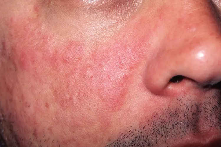photo of lupus on face