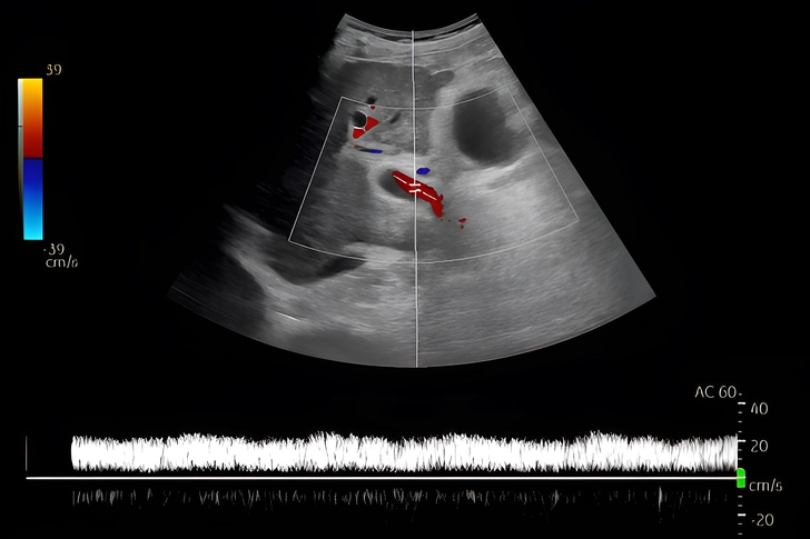 What Is Ultrasound Elastography?
