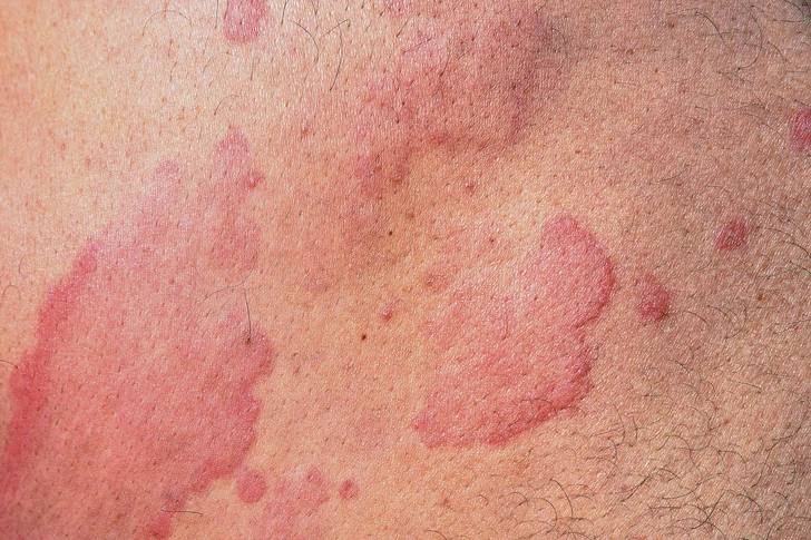 Rash