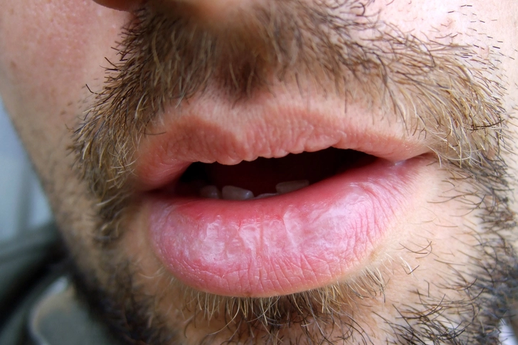 Dry Mouth