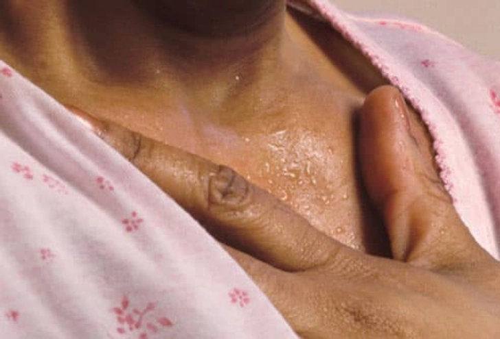 Symptom: Hot Flashes