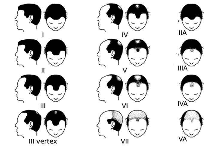 Male-Pattern Baldness: What to Expect