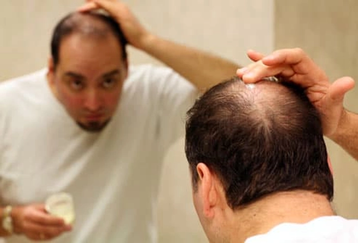 Hair Loss Medication: Minoxidil