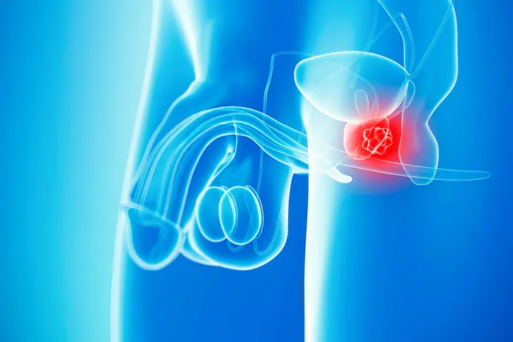 What Is Prostate Cancer?