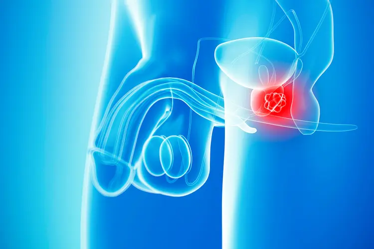 photo of prostate cancer