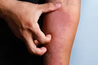 Atopic Dermatitis and Mental Health 