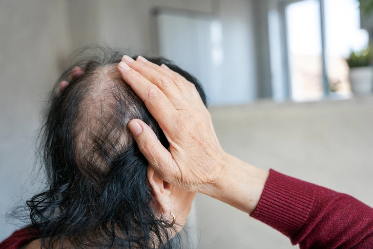 Hair Loss Hair Loss