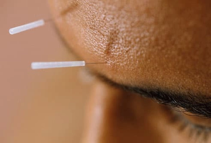 Alternative Therapy: Acupuncture