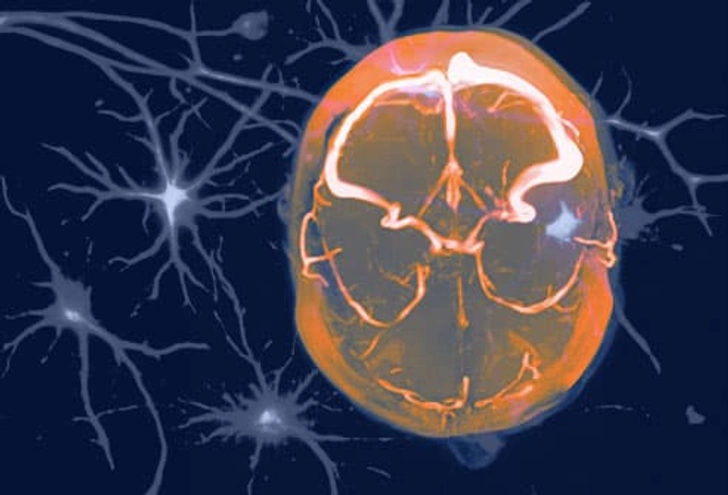 What Causes a Migraine?