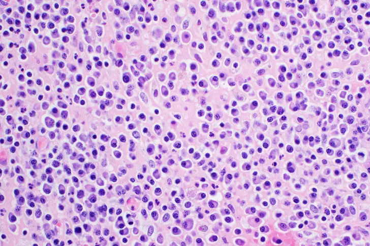 How is Having Multiple Myeloma Different For Black and Hispanic People? How is Having Multiple Myeloma Different For Black and Hispanic People?