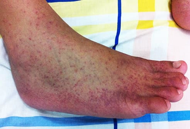 Chikungunya Chikungunya