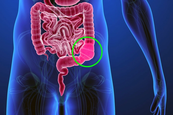 Constipation makes it worse. Constipation makes it worse.