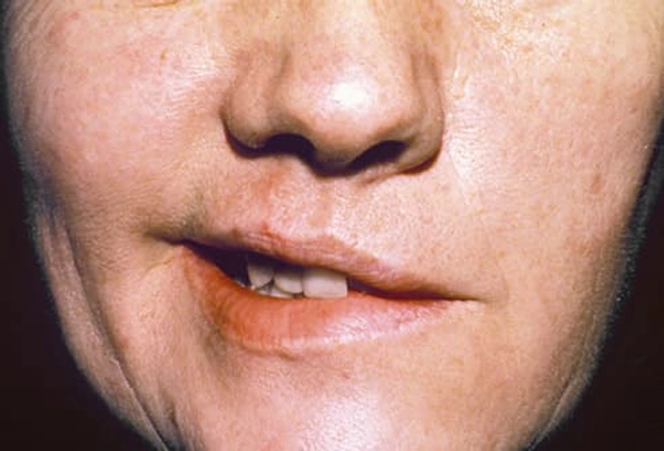 Fact: Shingles Can Hurt Your Brain