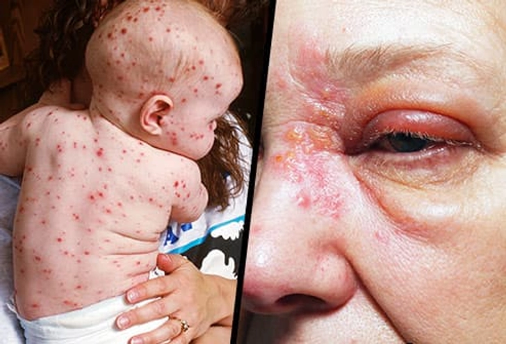 Myth: Chickenpox Is the Same Thing