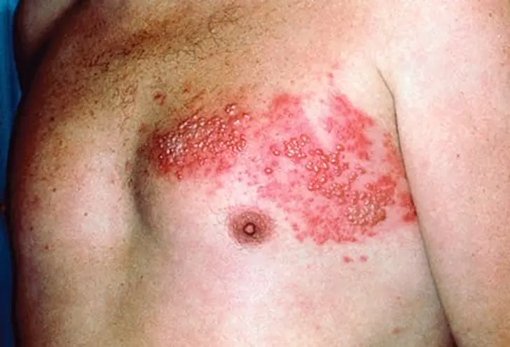 What Is Shingles? What Is Shingles?