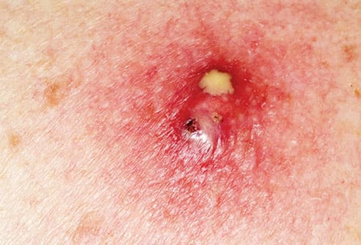 Fact: The Rash Can Get Infected
