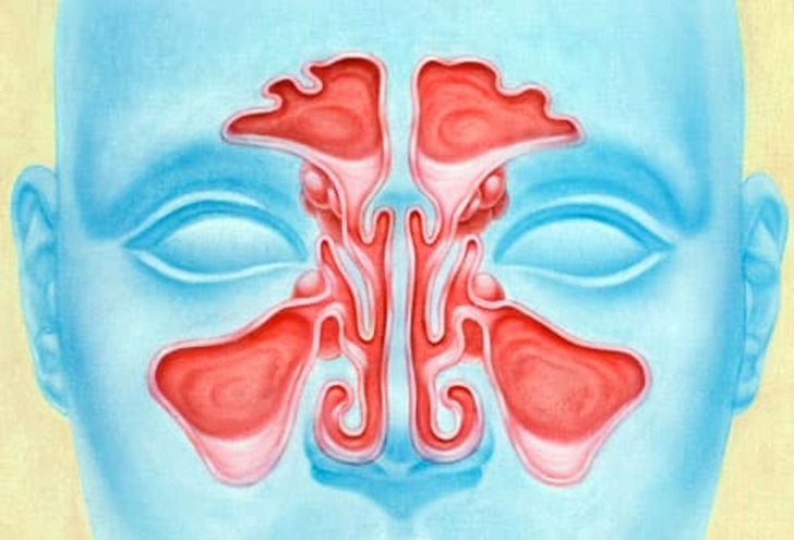 How Sinuses Get Clogged How Sinuses Get Clogged