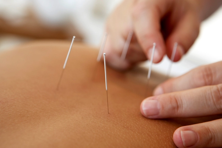 Acupuncture Acupuncture