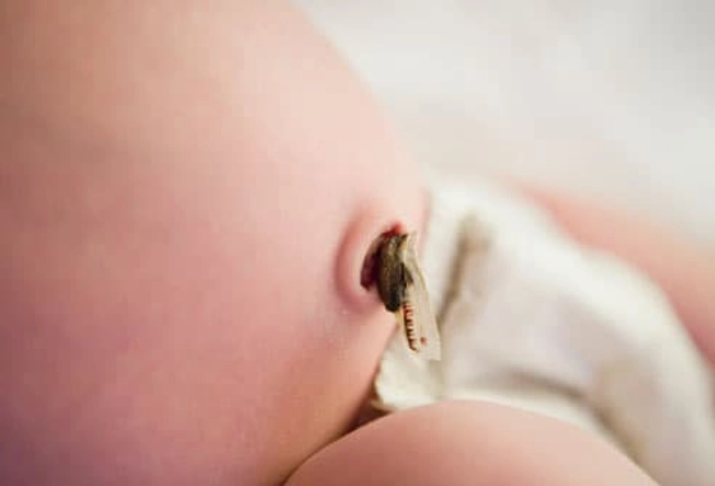 Umbilical Cord Stump Care Umbilical Cord Stump Care