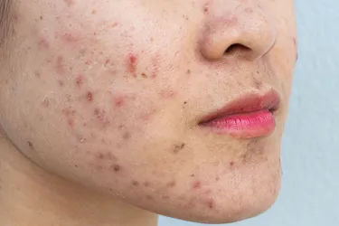 While acne usually pops up for teenagers, it is not uncommon in adults either with about 20% of cases occurring in adulthood. Photo credit: Moment/Getty Images