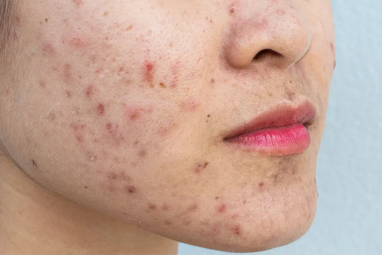 photo of acne on face