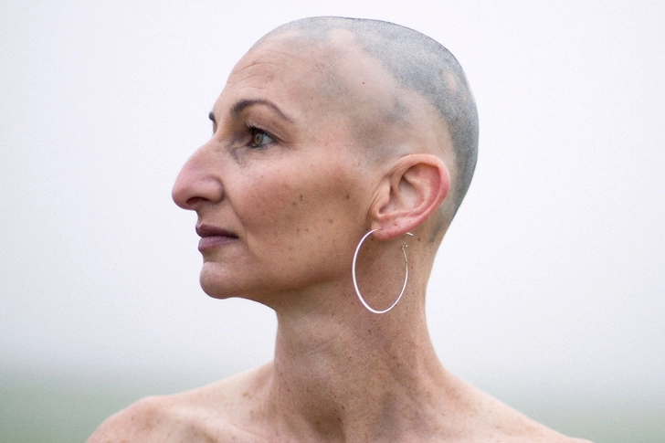 Alopecia Alopecia