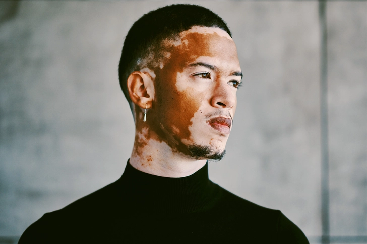 Vitiligo Vitiligo